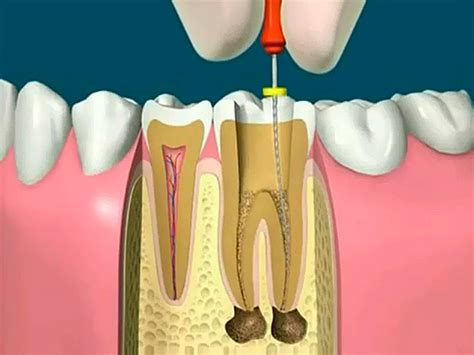 canal dentario